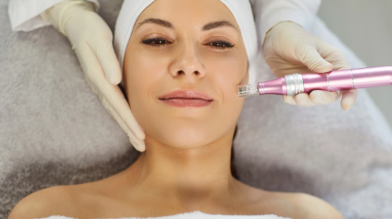 How Microneedling Helps Reduce Hyperpigmentation and Uneven Skin Tone